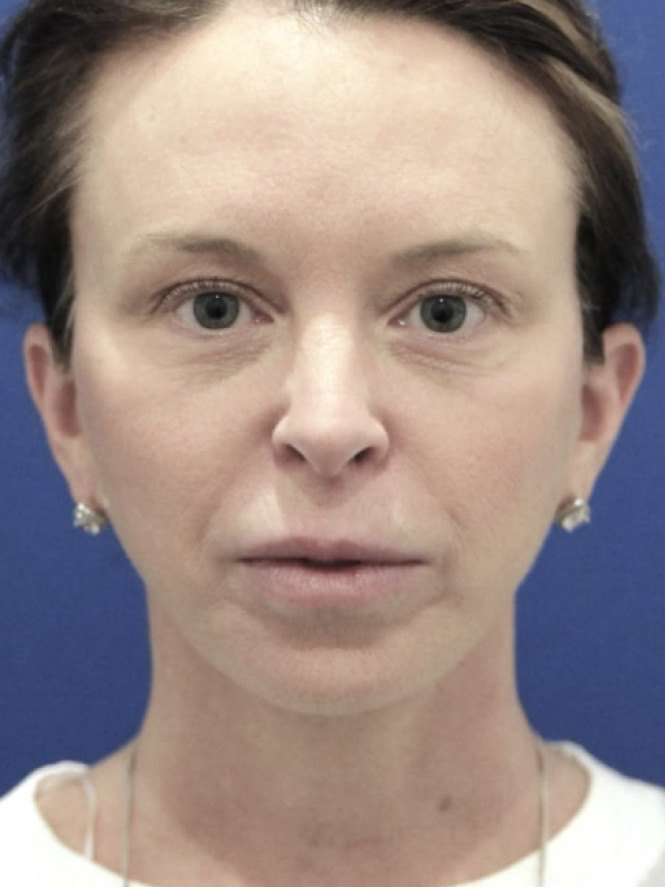 Jowling and Skin Laxity — After