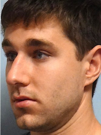 Crooked Nose & Dorsal Hump2* — Before