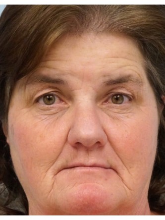 Brow Droop & Upper Eyelid Skin Excess* — Before