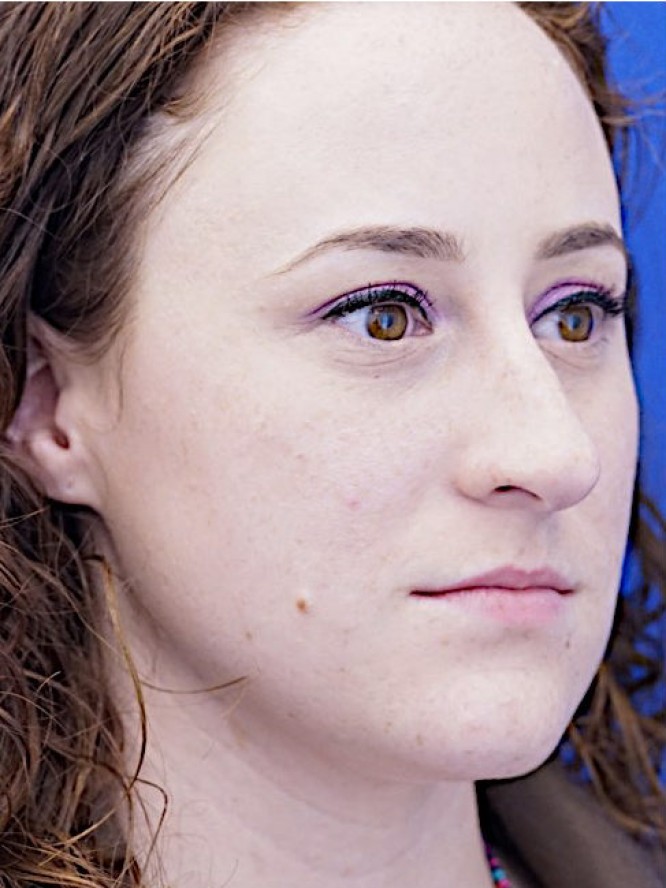 Finesse Nasal Contour — Before