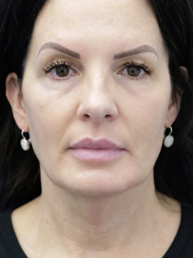 Deep Plane Cheek and Facelift — Before
