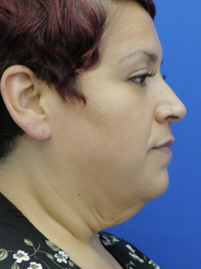 Necklift and Lower Facelift — Before