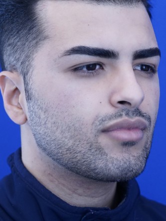 Vertical Lengthening Chin* — After