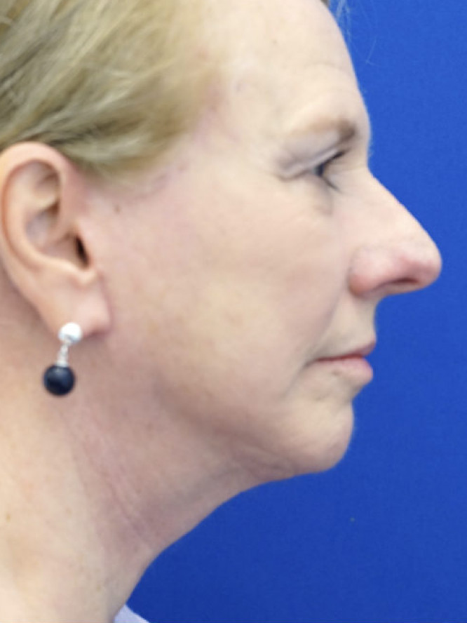 Lower Facial Aging and Fullness — After