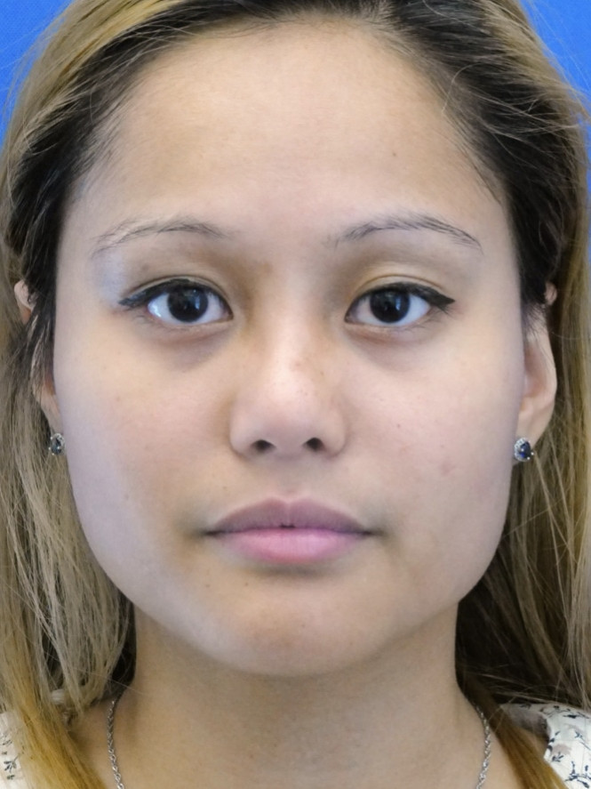 Eyelid Crease Deepening — Before