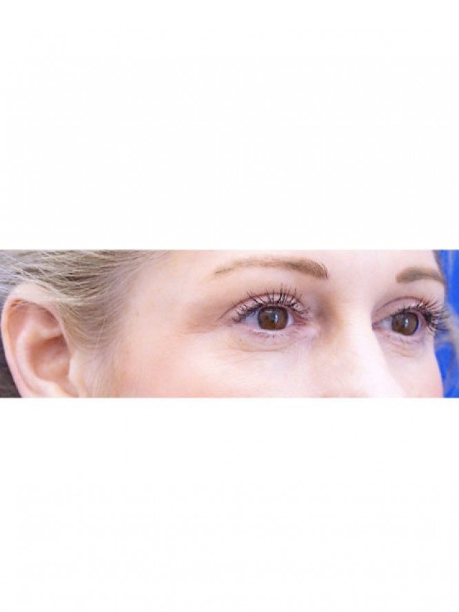 Lower Blepharoplasty and Fat Grafting — Before