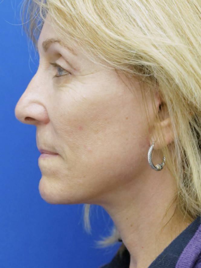 Hairline Browlift — After
