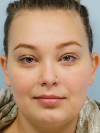 Restylane Silk Achieves Voluptuous Lips* — Before