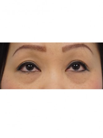 Lower Eyelid Fat Pseudoherniation* — Before