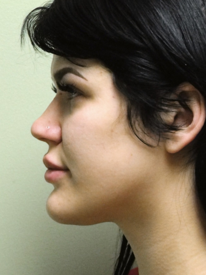 Soft Tissue and Bone Reduction — Before