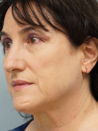 Mini Face and Neck Lift* — Before