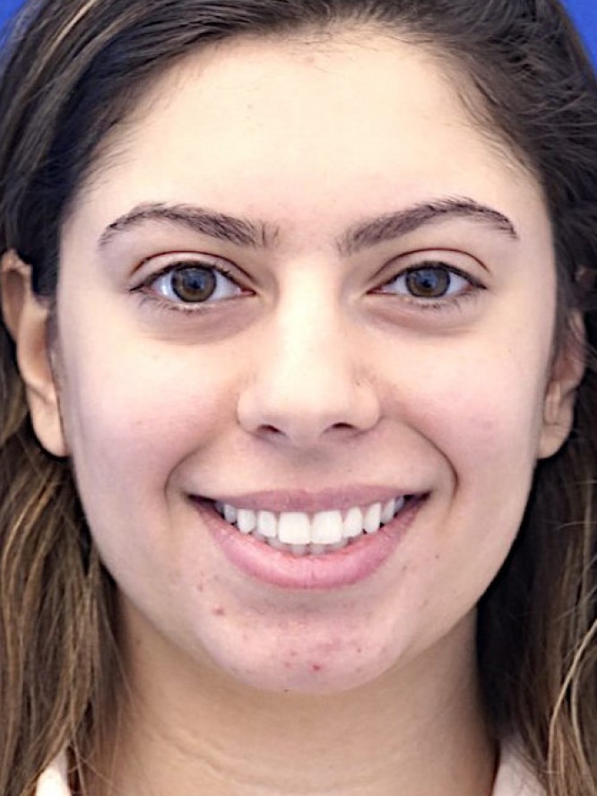 Hump Reduction and Chin Projection — Before