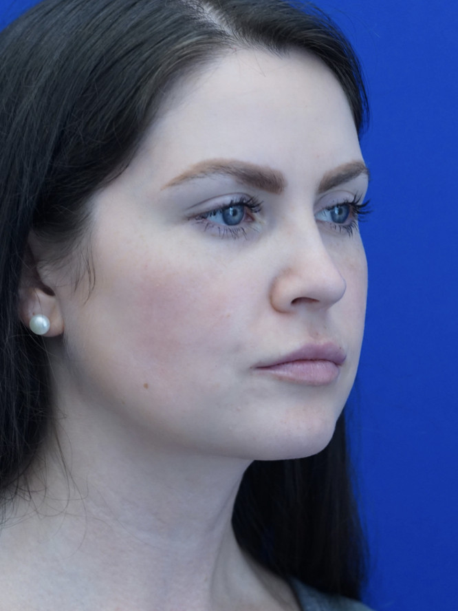 Nasal Tip and Narrow Cheek — After