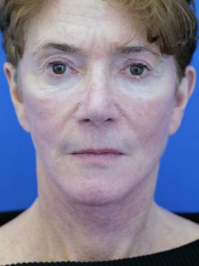 Deep Plane Facelift and Eyelid Lift — After