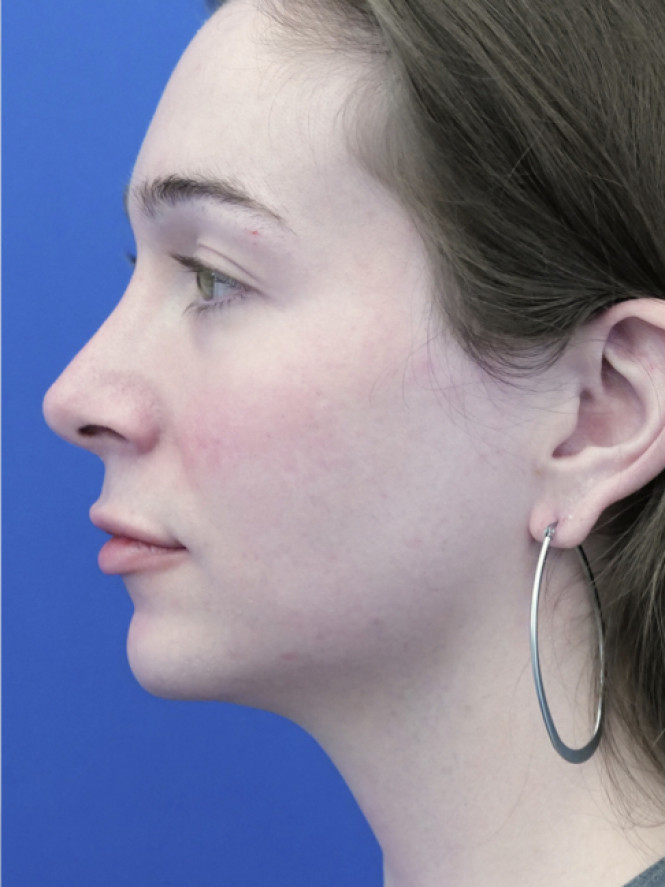 Soften Nasal Contour — After