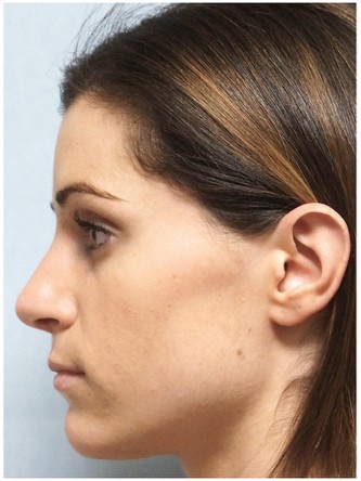 Mild Dorsal Hump & Droopy Tip1* — After