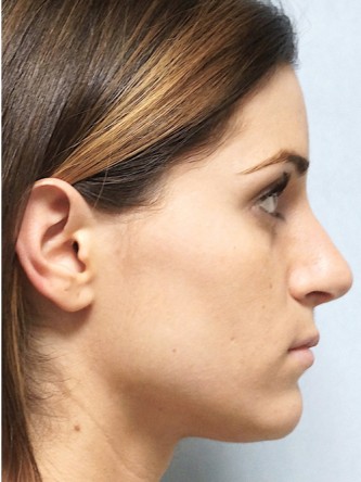 Mild Dorsal Hump & Droopy Tip1* — After