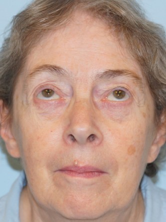 Visual Field Deficit – Eyelid Ptosis3* — Before