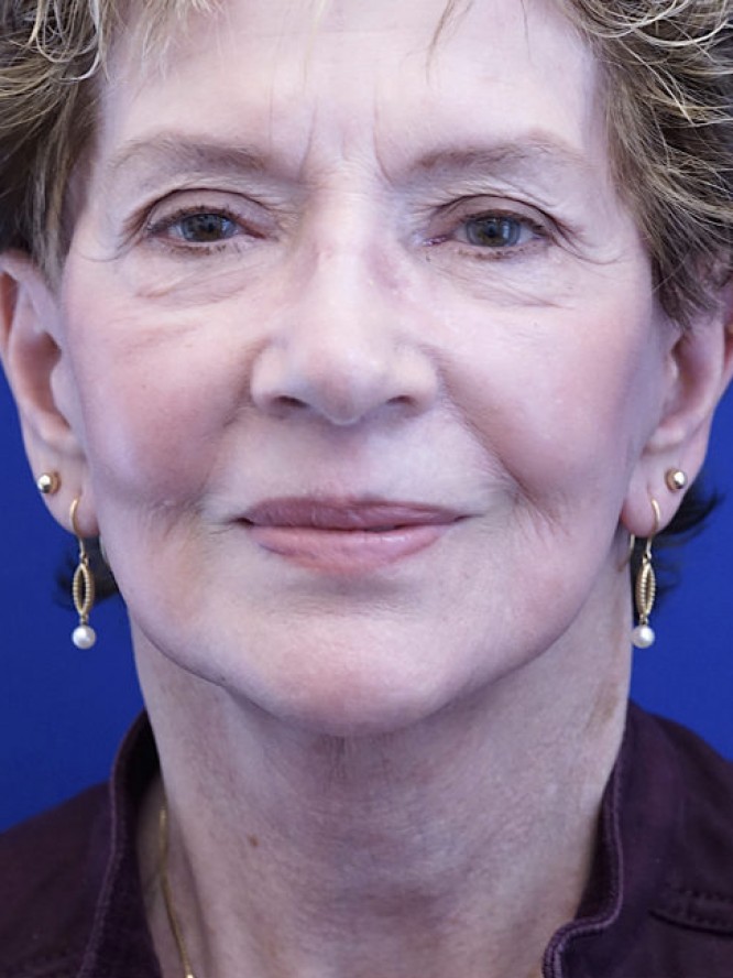 Deep Plane Facial Rejuvenation — After