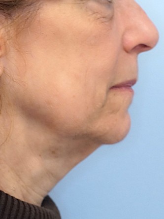 Full Face and Necklift, Upper and Lower Eyelid, Browlift* — Before