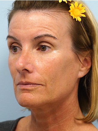 Voluma to Malar Cheek* — Before