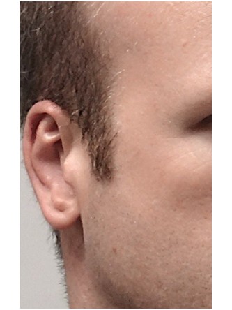 Protruding Ears – Moderate* — After