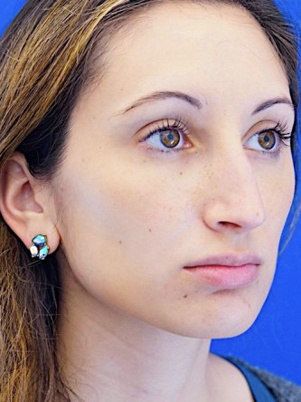 Nasal Profile Aesthetics — Before