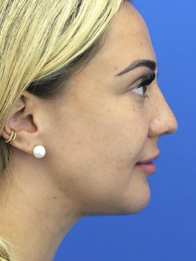 Lower Facial Rejuvenation — After