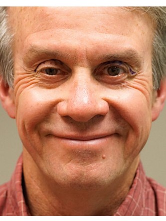 Droopy Eyelid Surgery* — Before