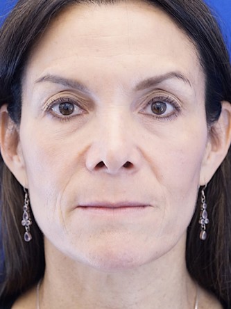 Nasal Tip Deformity — Before