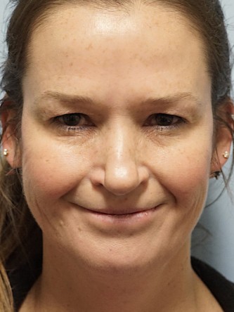 Excess Upper Eyelid Skin* — Before