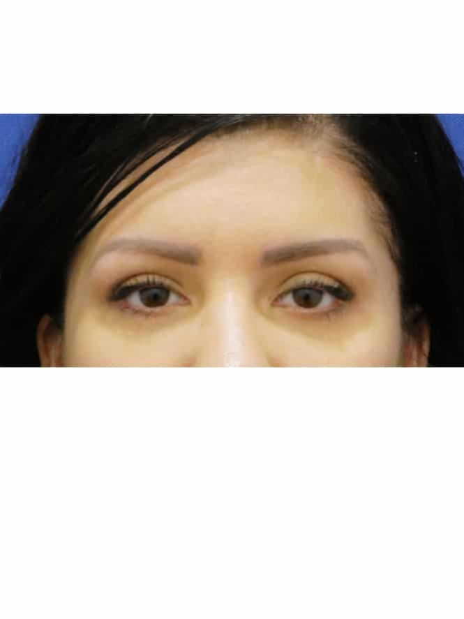 High Arched Brows — Before