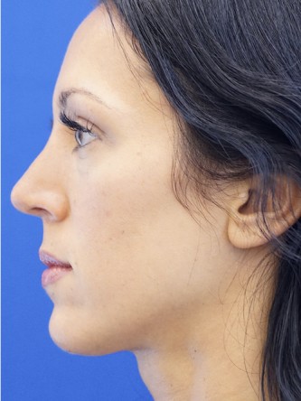 Hump Down Rotate Tip Up — After