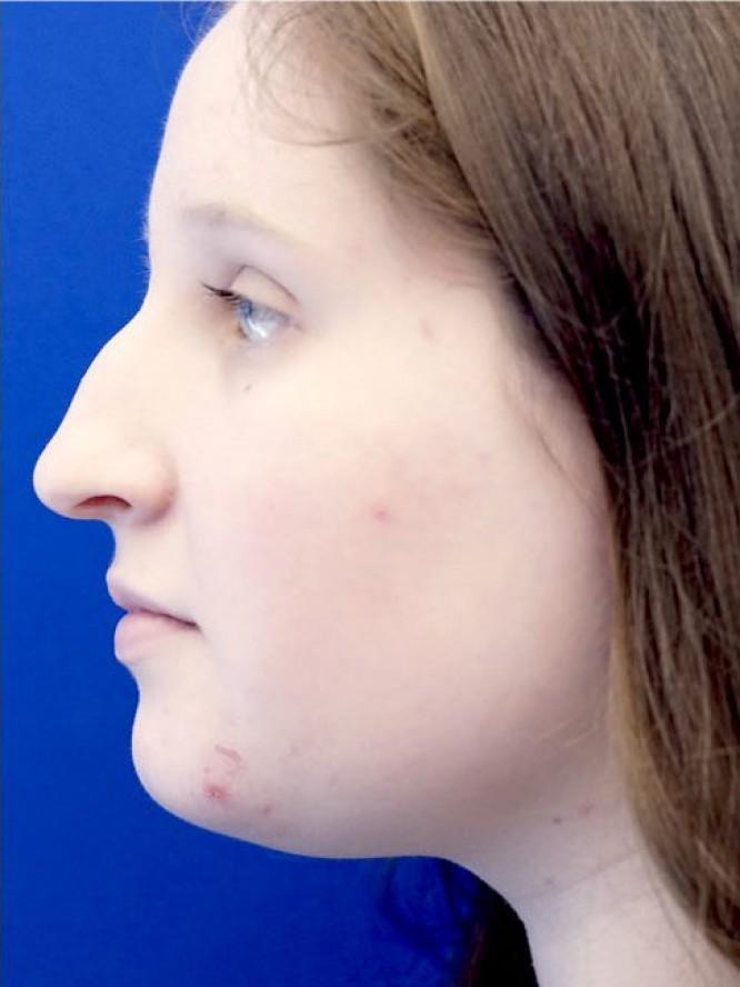 Reduction Dorsal Hump — Before