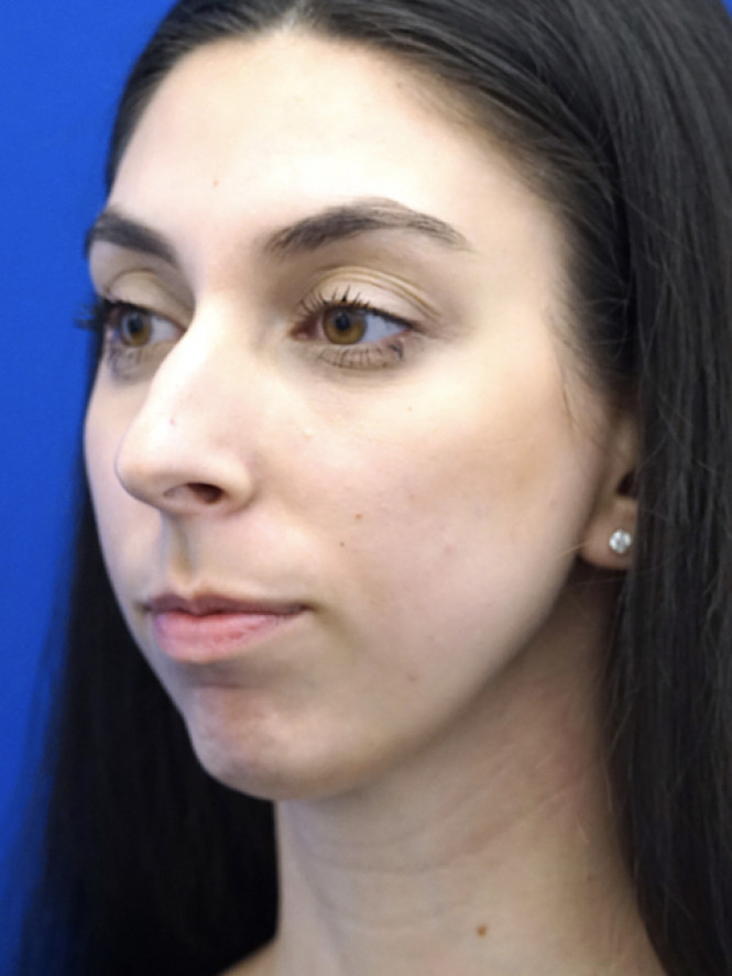 Facial Profile Balance — Before