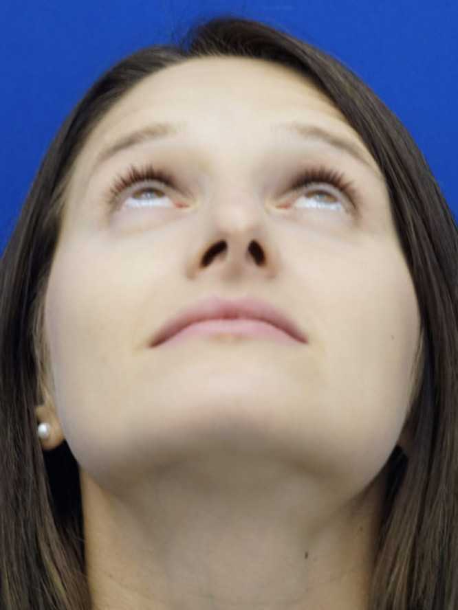 Nasal Profile Bliss — Before