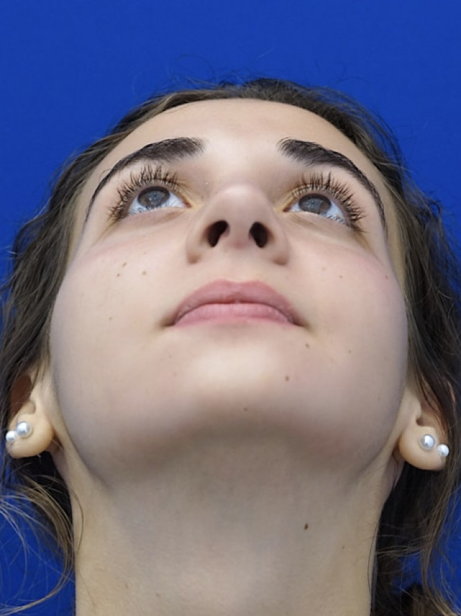 Classic Tension Nose — After