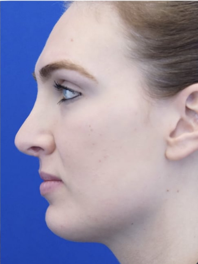 Tension Nose — After