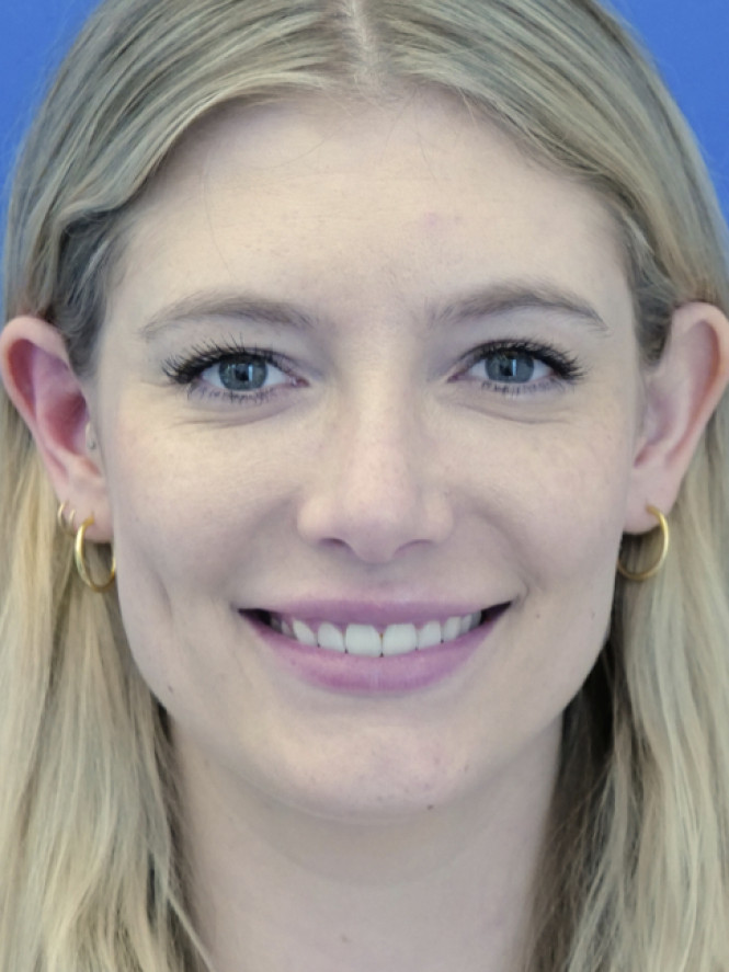 Aesthetic Nasal Contour — After