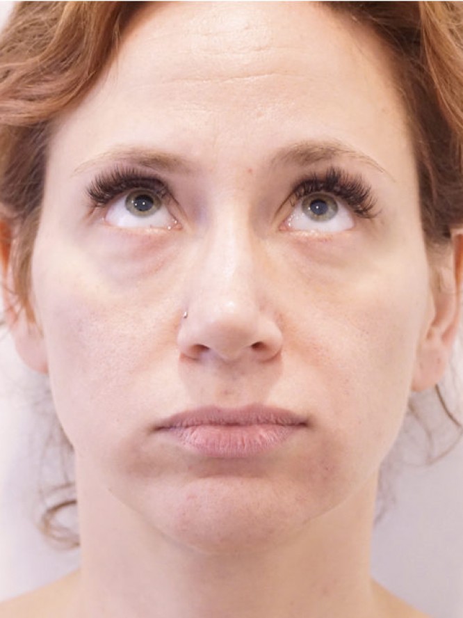 Under Eye Filling — After