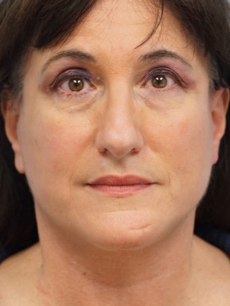 Mini Face and Neck Lift* — After