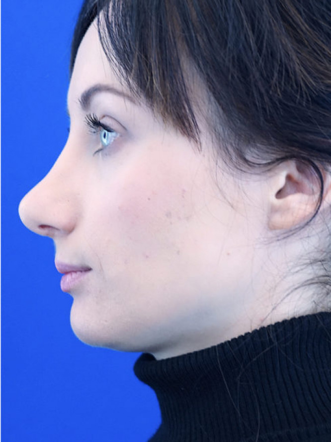 Gentle Dorsal Slope — After