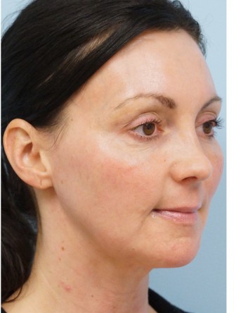 Fractional CO2 Laser Skin Resurfacing2* — After