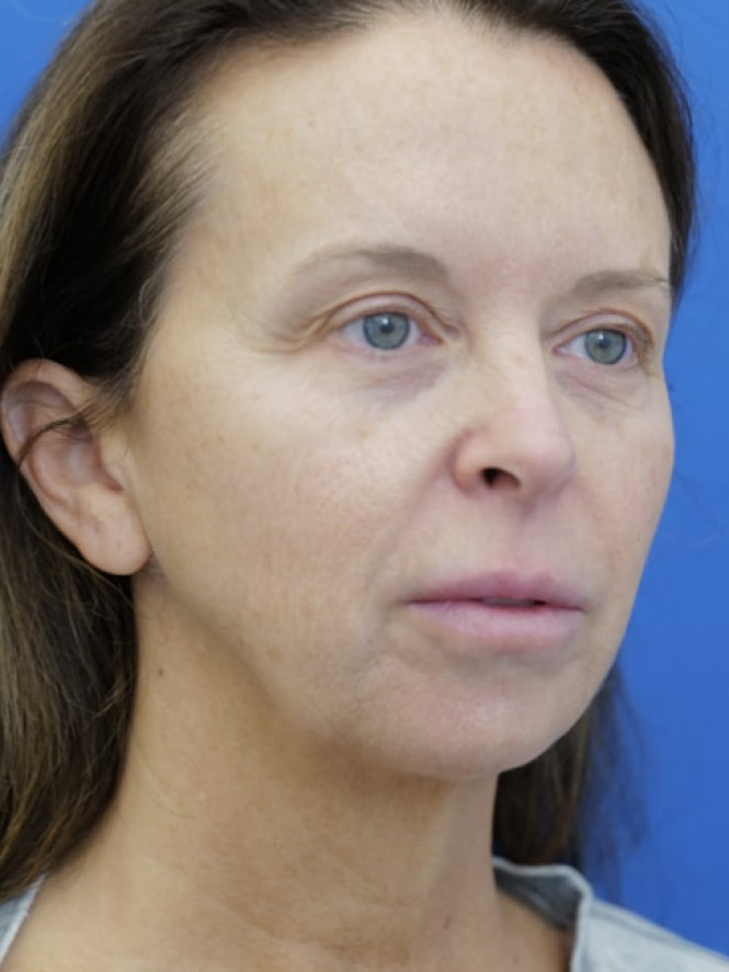 Jowling and Skin Laxity — Before