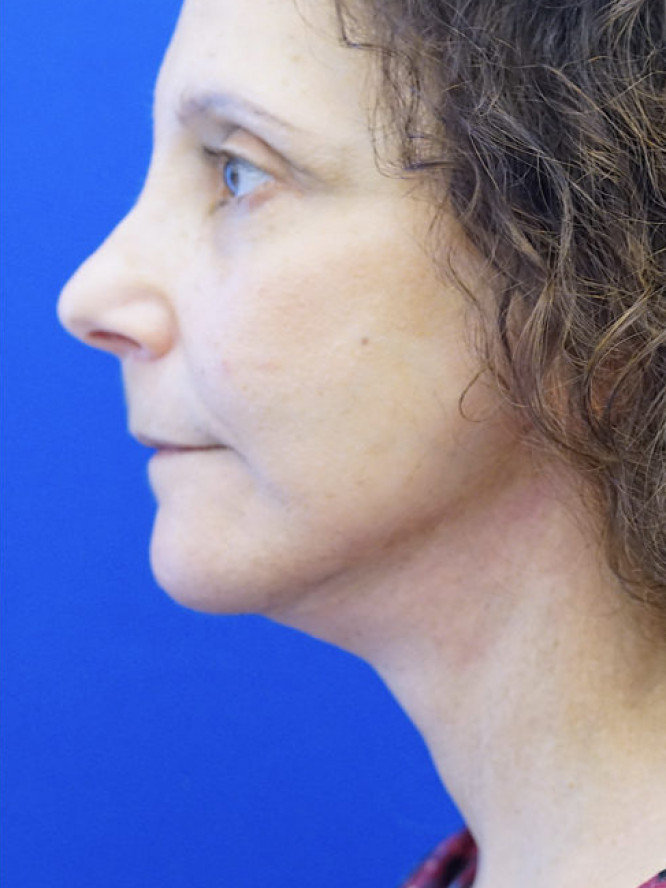 Deep Plane Facelift and Platysmaplasty — After