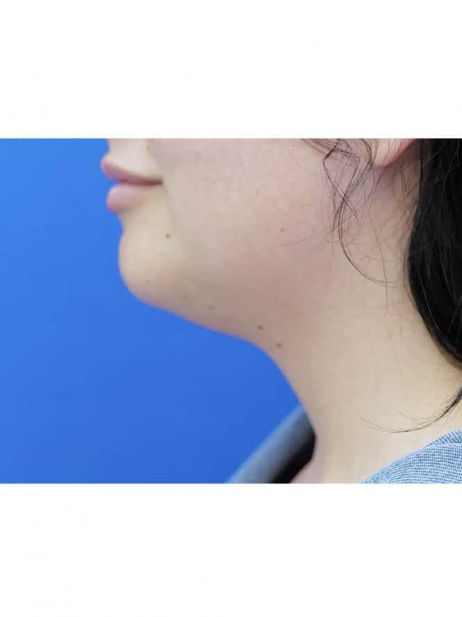 Platysmaplasty Without Skin Resection — Before