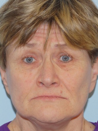 Endoscopic Browlift & Upper Eyelid Droop* — Before