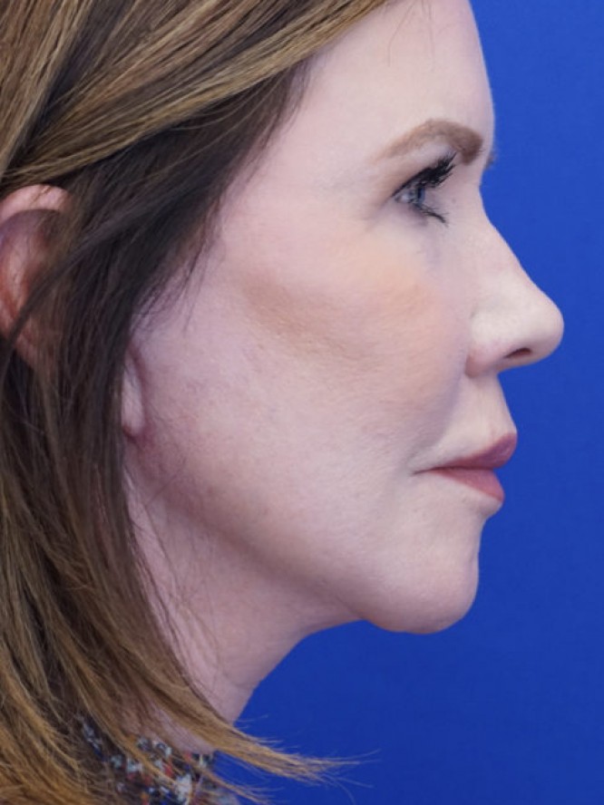 Secondary Lift and Facial Fat Grafting — After