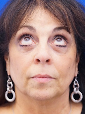 Lower Eyelid Fat Removal* — After