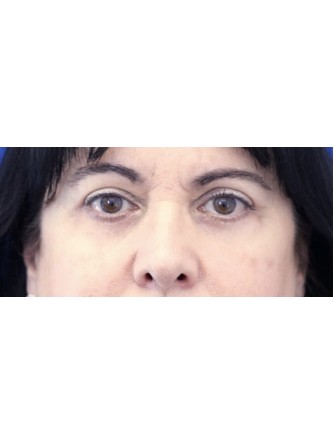 Upper and Lower Eyelid Loose Skin* — After